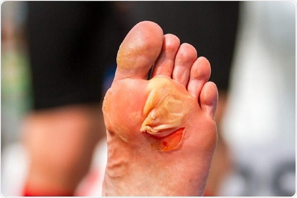 How to Take Care of Blisters on Feet? Essential Tips and Trick